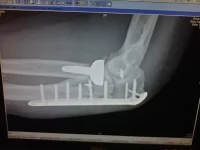 Pain